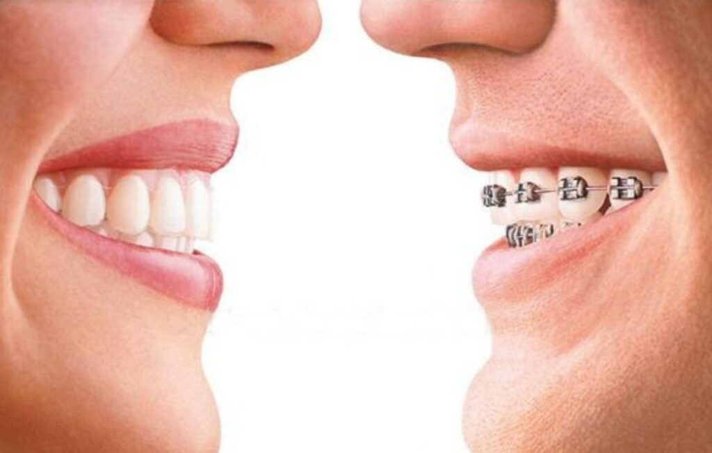 Alineadores Transparentes - Clínica Dental Guadalupe