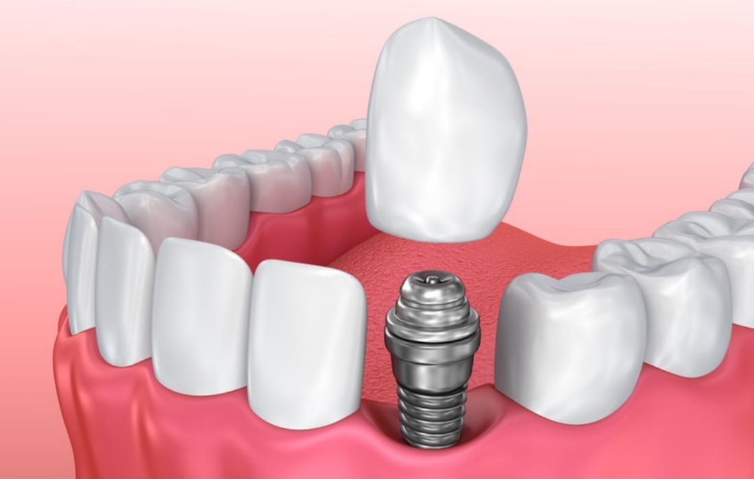 Tipos Implantes Dentales - Guadalupe - Murcia | Clínica Dental Guadalupe