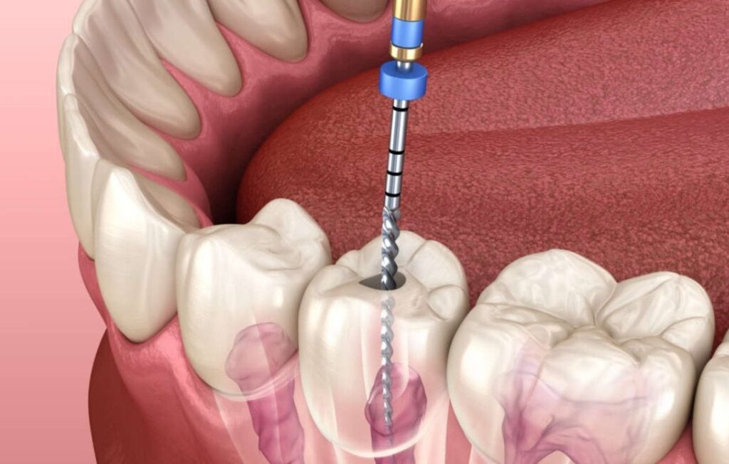 ¿Qué es una endodoncia? | Clínica Dental Guadalupe
