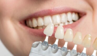 Tipos de Carillas Dentales - Guadalupe - Murcia | Clínica Dental Guadalupe