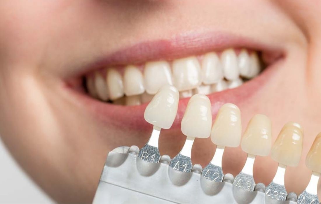 Tipos de Carillas Dentales - Guadalupe - Murcia | Clínica Dental Guadalupe