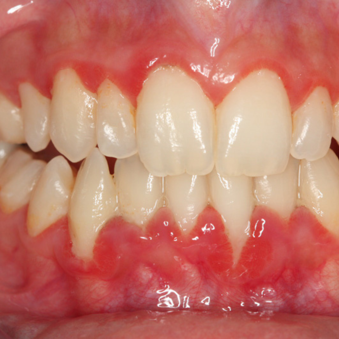 Qué es la periodontitis y cómo tratarla - Guadalupe - Murcia | Clínica Dental Guadalupe